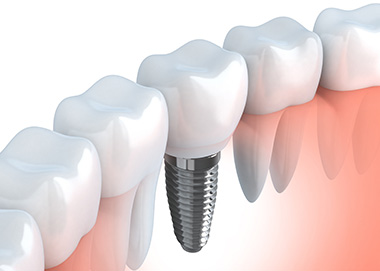 mutuelle dentaire Les implants